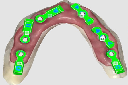 Medit's game-changing workflow for Revolutionizing All-on-X will launch soon