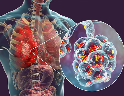 Legionnaires' Disease Lawyers at Pritzker Hageman Investigate Outbreak in Central Harlem
