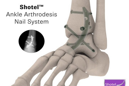 Growing Demand for Shotel™ Medical Expansion Signals Its Ankle Arthrodesis Device