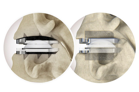 Centinel Spine's prodisc® C Vivo and prodisc C SK Cervical Total Disc Replacement System surpass 7,500 procedures in just two years.