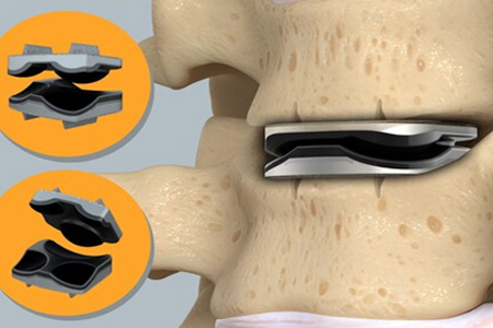First Patient Enrolled in Triadyme-C IDE Clinical Trial, Dymicron Announces