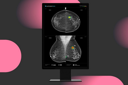 The world’s first large-scale, multicenter prospective study in single-reading mammography confirms that Lunit AI boosts cancer detection